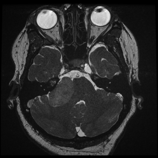 Acoustic schwannoma (Radiopaedia 57574-64536 Axial T2 39).png