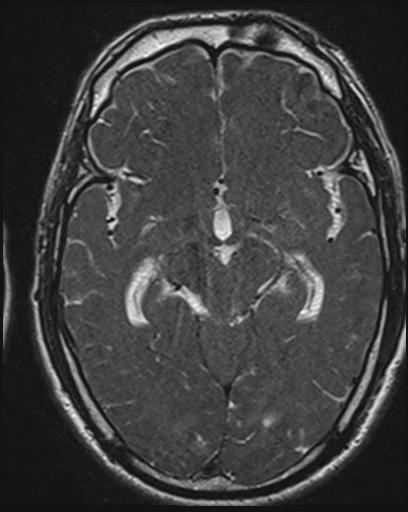 File:Acoustic schwannoma - probable (Radiopaedia 20386-20292 Axial T1 65).jpg