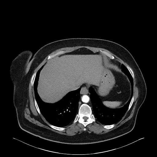 File:Acromioclavicular joint cyst (Radiopaedia 58455-65610 Axial 54).jpg