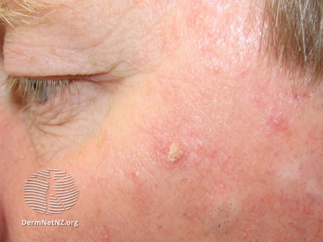 Actinic Keratoses affecting the face (DermNet NZ lesions-ak-face-562).jpg