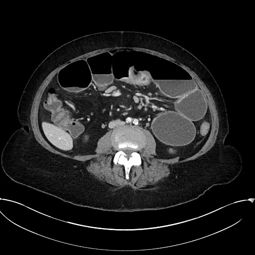 Active Crohn disease (Radiopaedia 59394-66750 Axial C+ portal venous phase 40).jpg