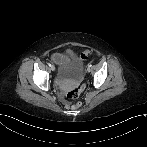 Active Crohn disease (Radiopaedia 59394-66750 Axial C+ portal venous phase 63).jpg