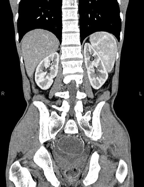 Active crohn disease (Radiopaedia 87133-103397 Coronal C+ arterial phase 47).jpg