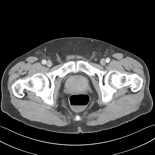 File:Active diverticular hemorrhage (Radiopaedia 39415-41725 Axial C+ portal venous phase 70).png