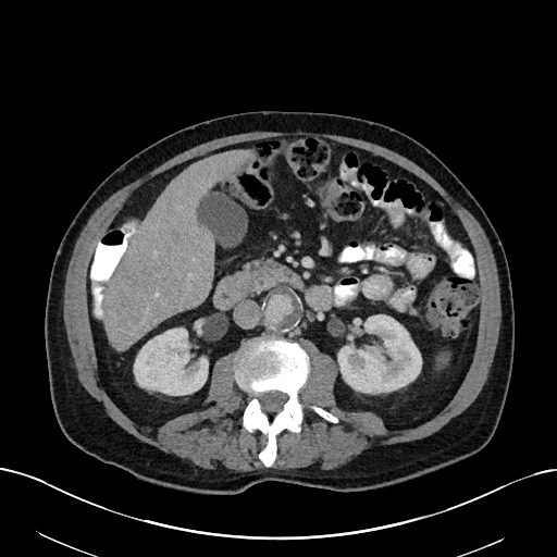 File:Active lower gastrointestinal bleeding - diverticular (Radiopaedia 61203-69106 Axial C+ portal venous phase 56).jpg
