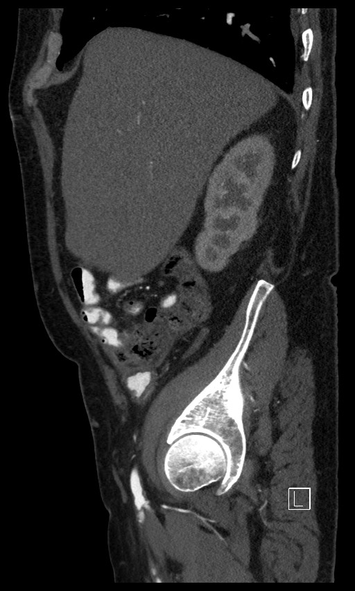 Active lower gastrointestinal bleeding - diverticular (Radiopaedia 61203-69106 Sagittal C+ arterial phase 122).jpg