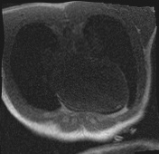 File:Active right ventricular cardiac sarcoidosis (Radiopaedia 55596-62100 Axial Dynamic perfusion scan MOCO 11).jpg