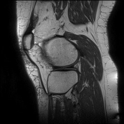 File:Acute-on-chronic transient lateral patellar dislocation with trochlear dysplasia (Radiopaedia 84099-99349 Sagittal PD 122).jpg