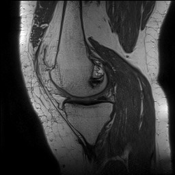Acute-on-chronic transient lateral patellar dislocation with trochlear dysplasia (Radiopaedia 84099-99349 Sagittal PD 63).jpg