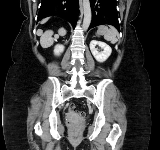 Acute appendicitis, heterotaxy syndrome (Radiopaedia 66884-76202 Coronal C+ portal venous phase 86).jpg