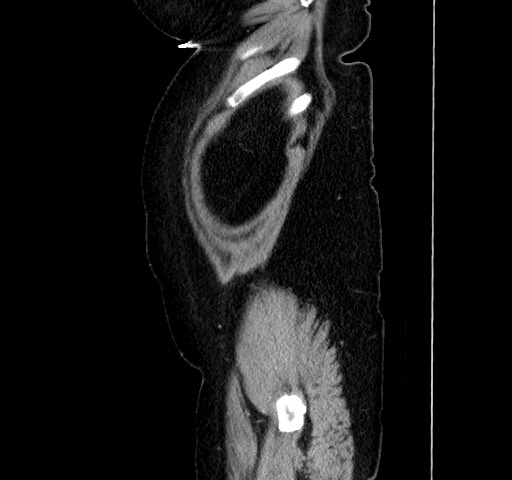 Acute appendicitis, heterotaxy syndrome (Radiopaedia 66884-76202 Sagittal C+ portal venous phase 22).jpg