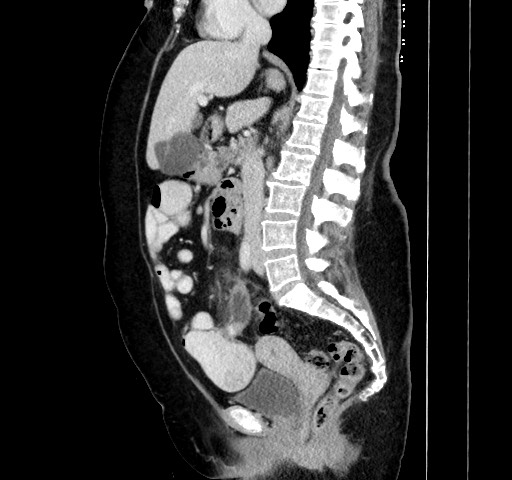 File:Acute appendicitis, heterotaxy syndrome (Radiopaedia 66884-76202 Sagittal C+ portal venous phase 68).jpg