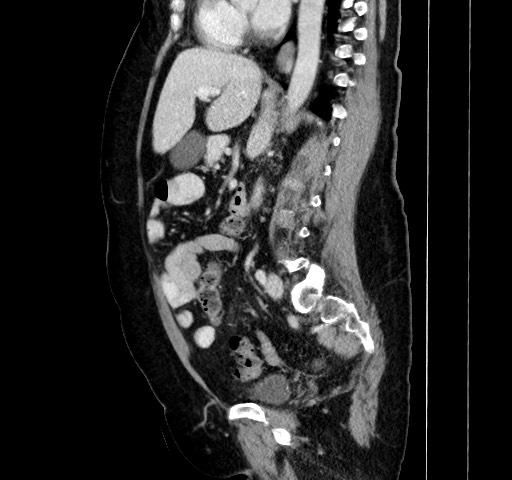 Acute appendicitis, heterotaxy syndrome (Radiopaedia 66884-76202 Sagittal C+ portal venous phase 78).jpg