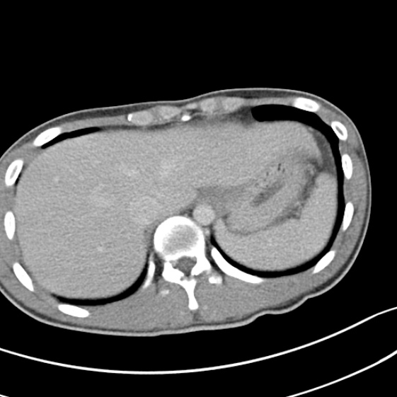 Acute appendicitis (Radiopaedia 32614-33572 Axial C+ portal venous phase 7).jpg