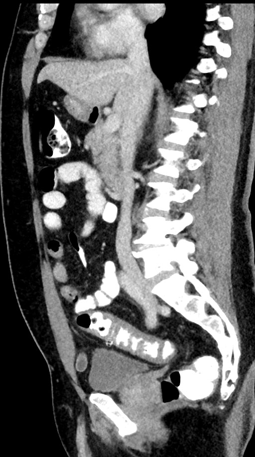 Acute appendicitis (Radiopaedia 77016-88960 Sagittal C+ portal venous phase 65).jpg