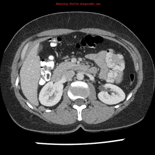 File:Acute appendicitis (Radiopaedia 7966-8812 C+ portal venous phase 14).jpg