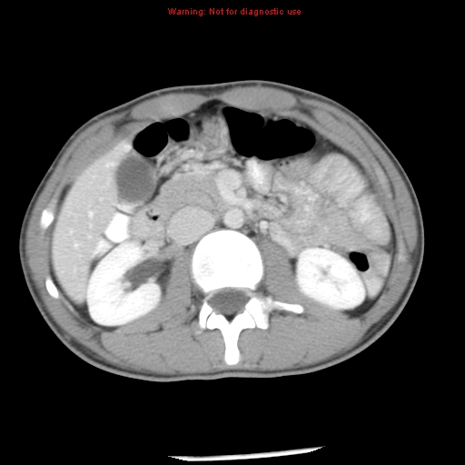 Acute appendicitis (Radiopaedia 8195-9045 Axial C+ portal venous phase 30).jpg