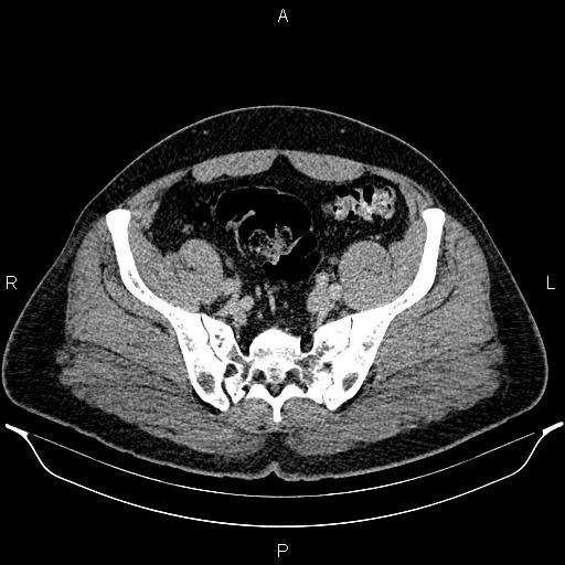 Acute appendicitis (Radiopaedia 84780-100240 Axial C+ portal venous phase 86).jpg