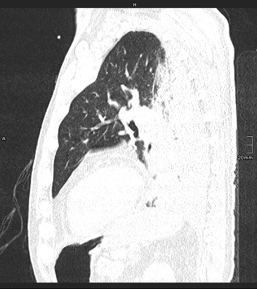 Acute aspiration pneumonitis (Radiopaedia 55642-62166 Sagittal lung window 45).jpg