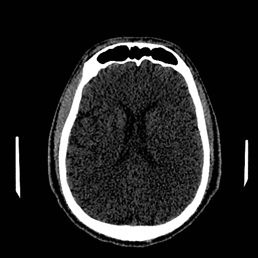 Acute basilar artery occlusion (Radiopaedia 43582-46985 Axial non-contrast 108).jpg