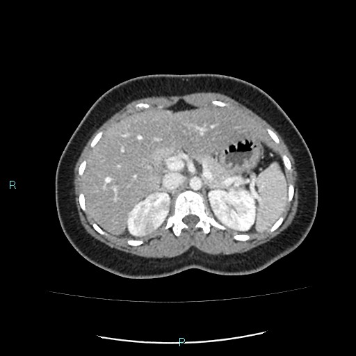 Acute bilateral pyelonephritis (Radiopaedia 37146-38881 Axial C+ portal venous phase 30).jpg