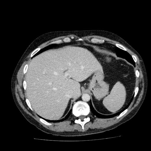 Acute cholecystitis and incidental left sided IVC (Radiopaedia 49352-54459 Axial C+ portal venous phase 36).jpg