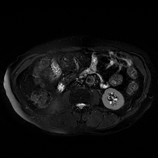 File:Acute cholecystitis complicated by pylephlebitis (Radiopaedia 65782-74915 Axial T2 fat sat 34).jpg