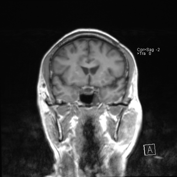 File:Acute disseminated encephalomyelitis (Radiopaedia 37253-39033 Coronal T1 11).jpg