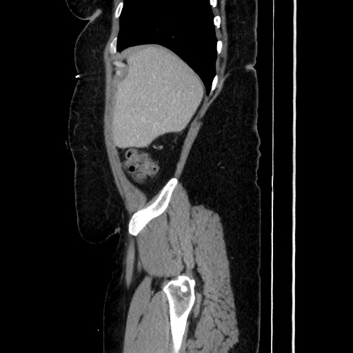 Acute diverticulitis - transverse colon (Radiopaedia 87063-103327 Sagittal C+ portal venous phase 63).jpg