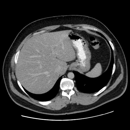 Acute diverticulitis with localized perforation (Radiopaedia 41296-44113 Axial C+ portal venous phase 18).jpg