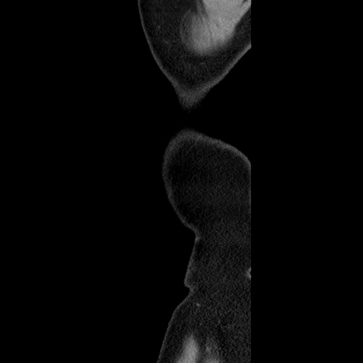 Acute diverticulitis with localized perforation (Radiopaedia 41296-44113 Sagittal C+ portal venous phase 6).jpg