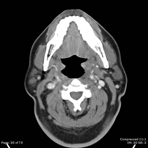 File:Acute epiglottitis (Radiopaedia 54375-60590 Axial 17).jpg