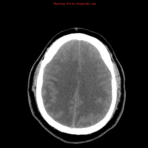 Acute hemorrhagic leukoencephalitis (Radiopaedia 14076-13920 Axial non-contrast 35).jpg