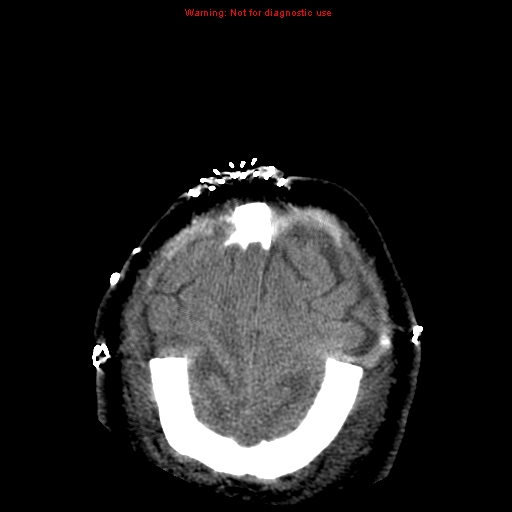 Acute hemorrhagic leukoencephalitis (Radiopaedia 14076-43697 Axial non-contrast 45).jpg