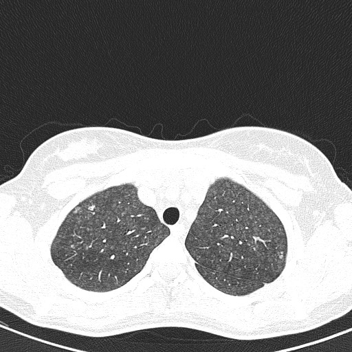 File:Acute hypersensitivity pneumonitis (Radiopaedia 85293-100870 Axial lung window 21).jpg
