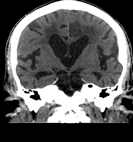 File:Acute left anterior cerebral artery territory infarction (Radiopaedia 51785-57578 Coronal non-contrast 30).jpg