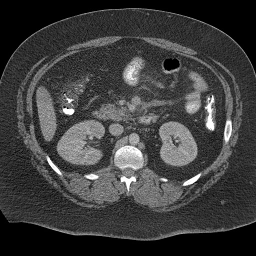 File:Acute mesenteric venous ischemia (Radiopaedia 46041-50383 Axial C+ portal venous phase 49).jpg