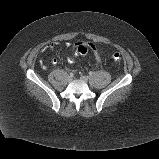 Acute mesenteric venous ischemia (Radiopaedia 46041-50383 Axial C+ portal venous phase 98).jpg