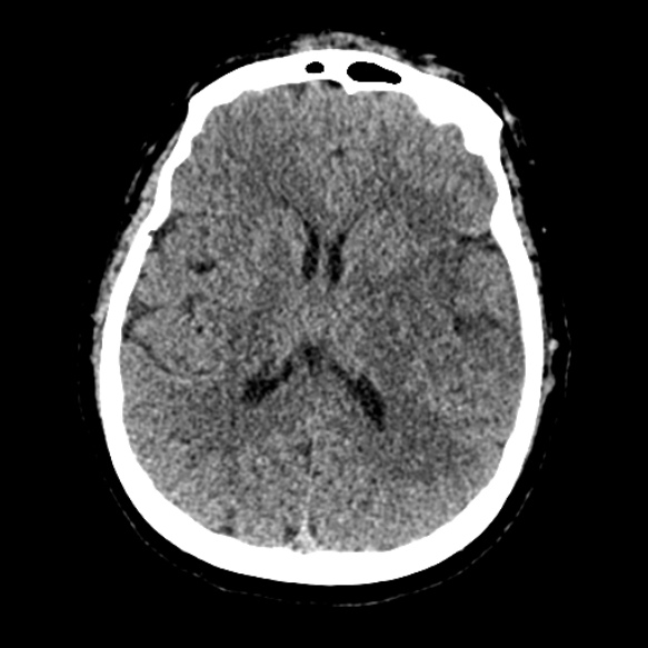 Acute middle cerebral artery territory infarct (Radiopaedia 52380-58283 Axial non-contrast 58).jpg