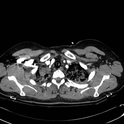 Acute myocardial infarction in CT (Radiopaedia 39947-42415 Axial C+ arterial phase 17).jpg