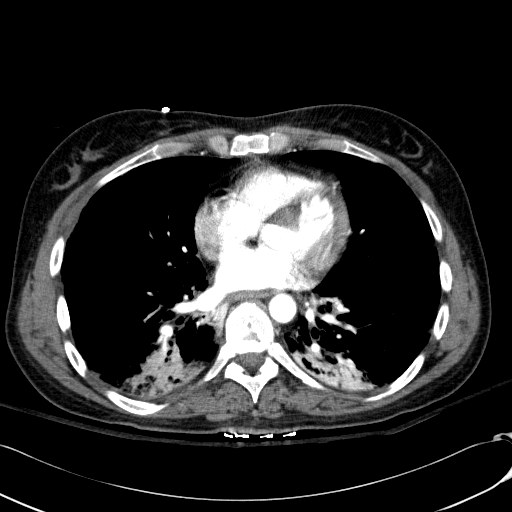 File:Acute myocardial infarction in CT (Radiopaedia 39947-42415 Axial C+ arterial phase 85).jpg