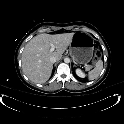 File:Acute myocardial infarction in CT (Radiopaedia 39947-42415 Axial C+ portal venous phase 30).jpg