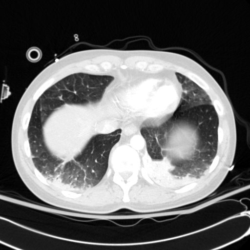Acute myocardial infarction in CT (Radiopaedia 39947-42415 Axial lung window 107).jpg