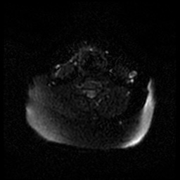 Acute otitis externa (Radiopaedia 57296-64236 Axial DWI 55).jpg