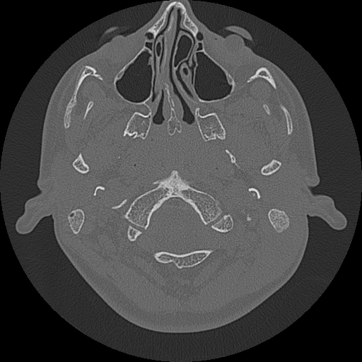 File:Acute otomastoiditis and Bezold abscess (Radiopaedia 88184-104786 Axial bone window 11).jpg
