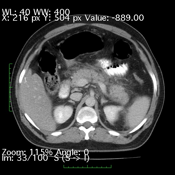 File:Acute pancreatitis (Radiopaedia 34043-35276 Axial C+ portal venous phase 33).jpg
