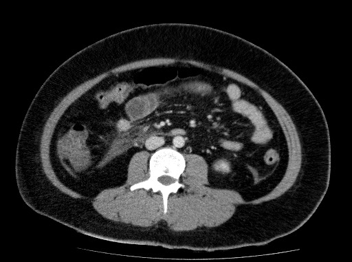 File:Acute pancreatitis (Radiopaedia 69236-79012 Axial C+ portal venous phase 51).jpg