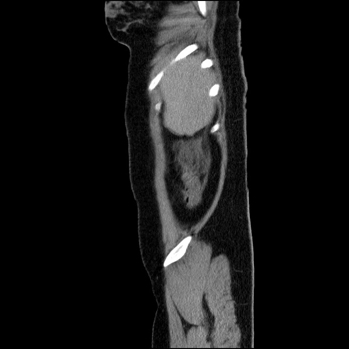 Acute pancreatitis (Radiopaedia 69236-79012 Sagittal C+ portal venous phase 85).jpg