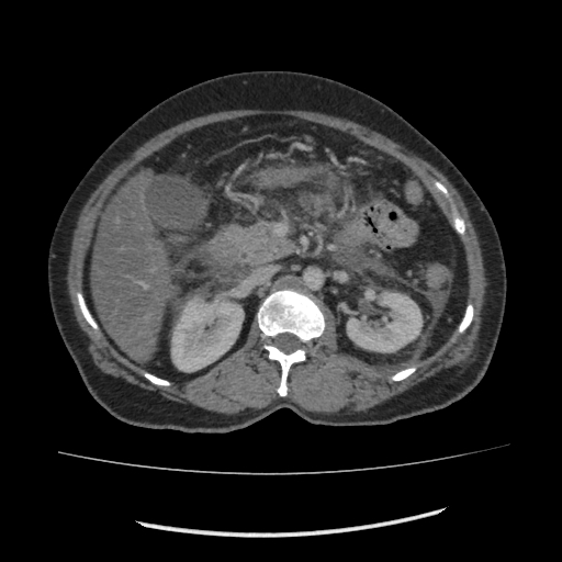 Acute pancreatitis (Radiopaedia 80007-93285 Axial C+ portal venous phase 69).jpg