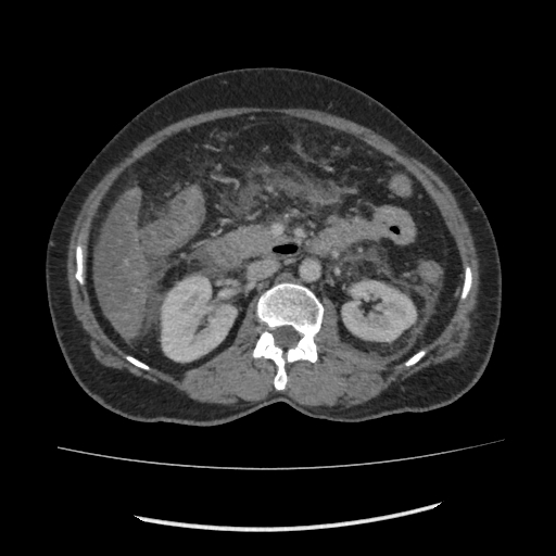 Acute pancreatitis (Radiopaedia 80007-93285 Axial C+ portal venous phase 81).jpg
